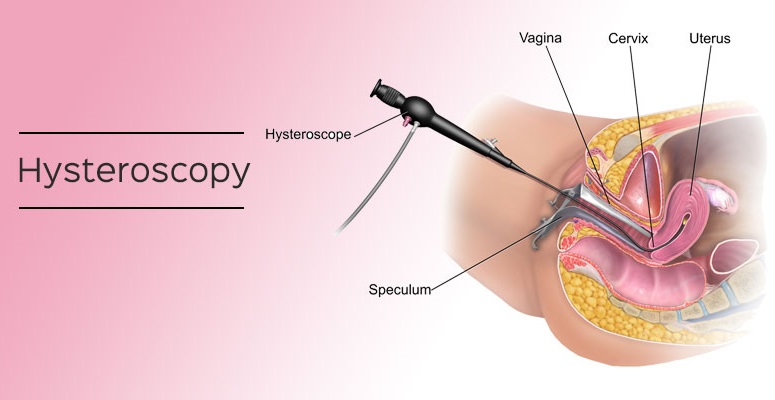 What is Advanced Hysteroscopy Treatment?